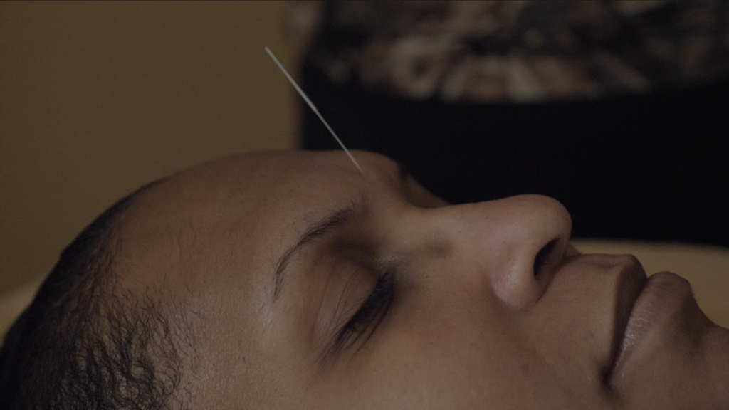 woman receiving acupuncture